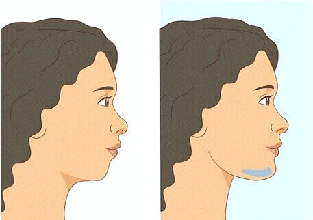 Why Is My Chin So Long? Causes, Types, and How to Fix It